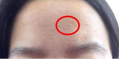 ​什么是闭口粉刺（你脸上长的小疙瘩是闭口还是黑头）