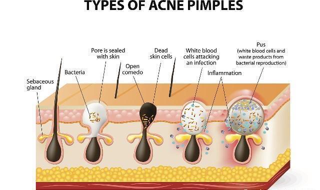 护肤品致痘成分大盘点,长痘的最大“元凶”到底是谁?
