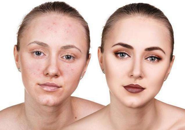 护肤品致痘成分大盘点,长痘的最大“元凶”到底是谁?