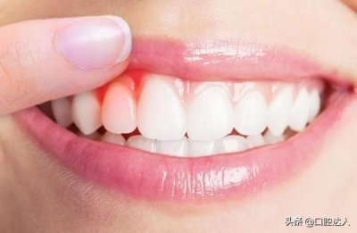 ​惊呆！没想到你居然是这样的牙结石…