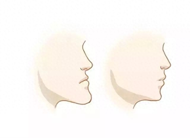 什么是地包天？地包天长什么样子？地包天牙齿图片