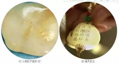 ​女婴带“玉”出生！医生说全世界都极为罕见