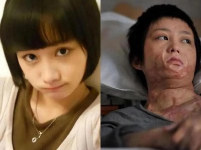​12年前被官二代被泼汽油毁容的少女周岩，现如今怎样了