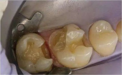 ​牙被蛀了，如何确定烂到了牙神经？