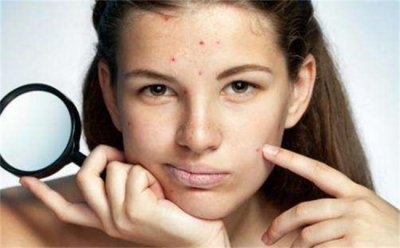 ​脸上长痘痘是什么原因