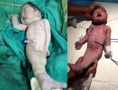 ​印度妈妈生下现实版“美人鱼” 宝宝4小时后不幸夭折